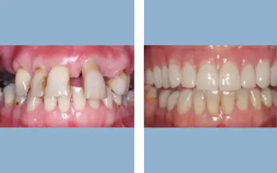 Before and After